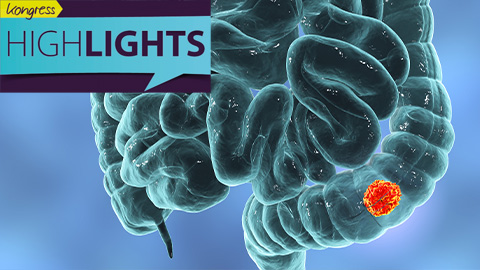 Grafische Darstellung des menschlichen Darms mit hervorgehobenem Tumorbereich Grafische Darstellung des menschlichen Darms mit hervorgehobenem Tumorbereich.