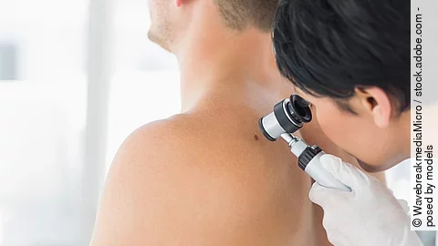 Hautkrebsscreening unter der Lupe