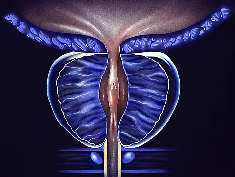 Prostata: Speicheltest für Erkennung von Prostatakrebs