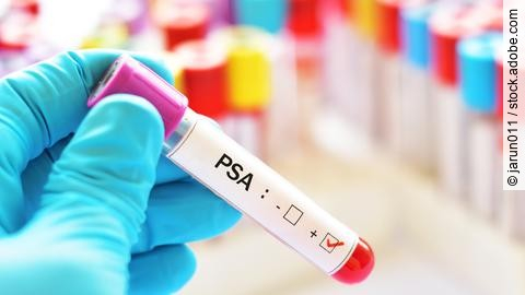 Blood sample positive with PSA, tumor marker for prostate cancer