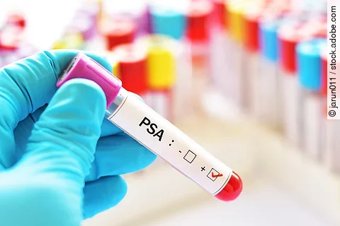 Blood sample positive with PSA, tumor marker for prostate cancer