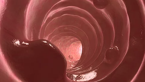 das Innere des Dickdarms mit mehreren unterschiedlich großen Polypen, die aus der Schleimhaut hervortreten