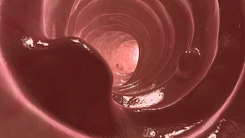 das Innere des Dickdarms mit mehreren unterschiedlich großen Polypen, die aus der Schleimhaut hervortreten