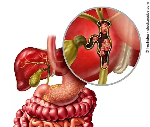 Gallenblase mit Cholangiokarzinom_grafische Darstellung