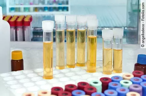 Urinproben: Ein internationales Forschungsteam hat neue Urin-Biomarker entdeckt, die Prostatakrebs präziser erkennen als der PSA-Wert