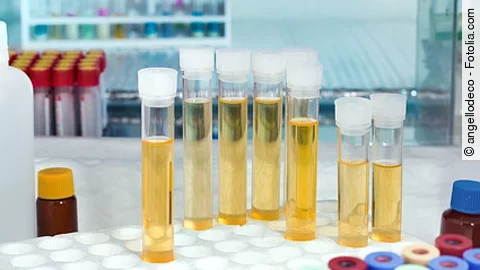 Urinproben: Ein internationales Forschungsteam hat neue Urin-Biomarker entdeckt, die Prostatakrebs präziser erkennen als der PSA-Wert