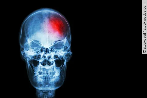 Röntgenaufnahme eines Schädelknochens mit einem roten Punkt als Zeichen einer Läsion - ein Tumor oder auch ein Schlaganfalll