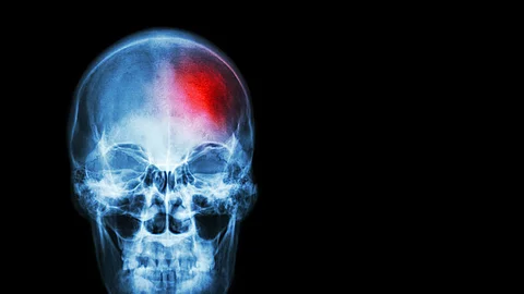 Röntgenaufnahme eines Schädelknochens mit einem roten Punkt als Zeichen einer Läsion - ein Tumor oder auch ein Schlaganfalll Röntgenaufnahme eines Schädelknochens mit einem roten Punkt als Zeichen einer Läsion - ein Tumor oder auch ein Schlaganfalll