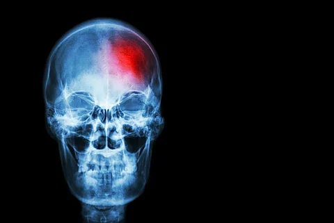 Röntgenaufnahme eines Schädelknochens mit einem roten Punkt als Zeichen einer Läsion - ein Tumor oder auch ein Schlaganfalll