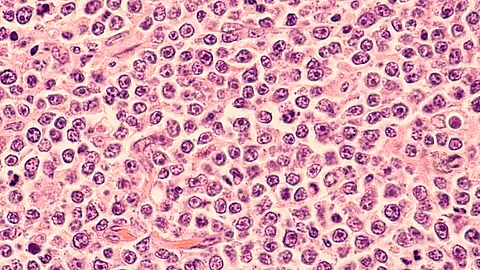Histologisches Bild eines diffusen großzelligen B-Zell-Lymphoms (DLBCL), einer Form des Non-Hodgkin-Lymphoms.