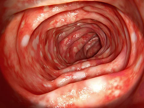 Colitis ulcerosa