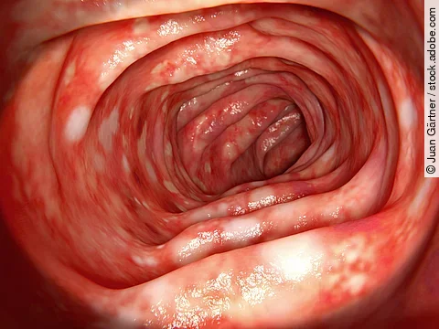 Colitis ulcerosa. Sie ist eine chronisch-entzündliche Darmerkrankung