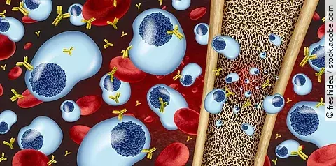 Konzept des Multiplen Myeloms und Plasmazellkrebs als Krebsgeschwür im Knochenmark mit 3D-Illustrationselementen.