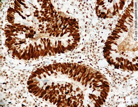 Malignant glands of a colon cancer with strong brown expression of the mismatch repair protein called MSH2. Microscopic view. Immunohistochemistry.