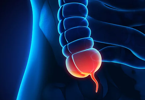 Entzündeter Wumfortsatz