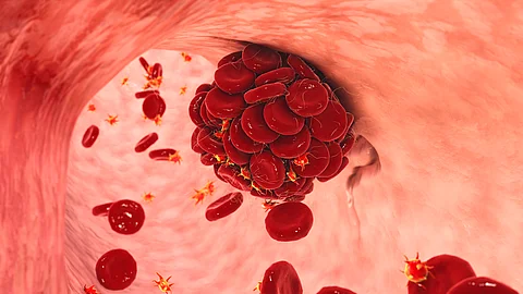 Thrombus in einem Blutgefäß