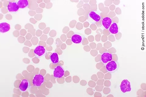 Blutbild bei chronischer lymphatischer Leukämie (CLL), mikroskopisch analysiert, Originalvergrößerung 1000-fach