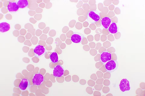 Blutbild bei chronischer lymphatischer Leukämie (CLL), mikroskopisch analysiert, Originalvergrößerung 1000-fach
