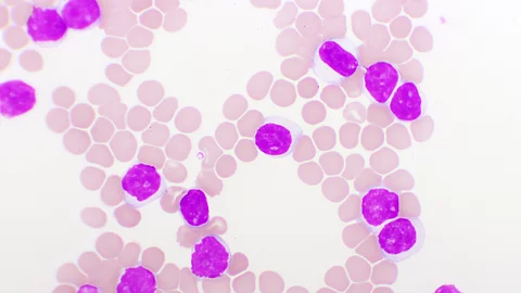 Blutbild bei chronischer lymphatischer Leukämie (CLL), mikroskopisch analysiert, Originalvergrößerung 1000-fach
