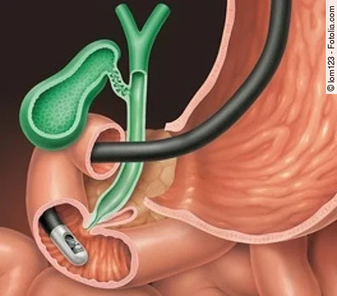 ERCP der Gallenblase