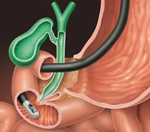 ERCP der Gallenblase