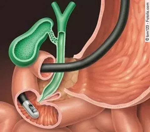 ERCP der Gallenblase