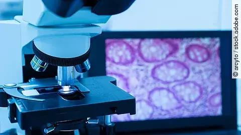 Modernes Mikroskop und Objektträger mit menschlichem Gewebe, auf dem Computerbildschirm wird ein Drüsenbild angezeigt.Selective focus. Modernes Mikroskop und Objektträger mit menschlichem Gewebe, auf dem Computerbildschirm wird ein Drüsenbild angezeigt.