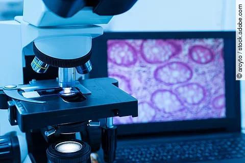 Modernes Mikroskop und Objektträger mit menschlichem Gewebe, auf dem Computerbildschirm wird ein Drüsenbild angezeigt.
