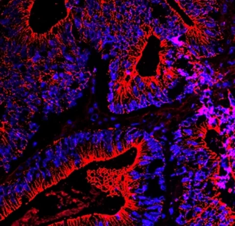 Dickdarmkrebs unter dem Fluoreszenzmikroskop