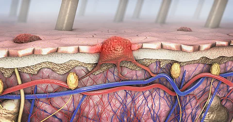 Illustration der Hautschichten mit einer roten Tumorformation, die sich in die Haut und das darunterliegende Gewebe ausbreitet, umgeben von Blutgefäßen und Nerven.