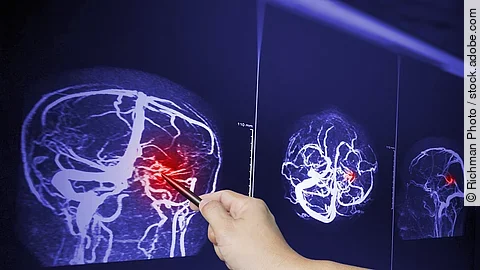 Close up Hand doctor point MRA brian scan image of a recent trau