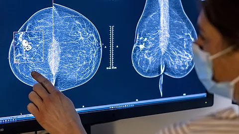 Monitor mit zwei Mammografieaufnahmen, auf die eine Person mit einer Hand deutet; die Aufnahmen zeigen unterschiedliche Gewebestrukturen der Brust. Monitor mit zwei Mammografieaufnahmen, auf die eine Person mit einer Hand deutet; die Aufnahmen zeigen unterschiedliche Gewebestrukturen der Brust.