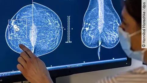 Monitor mit zwei Mammografieaufnahmen, auf die eine Person mit einer Hand deutet; die Aufnahmen zeigen unterschiedliche Gewebestrukturen der Brust.