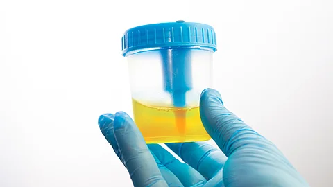 Eine blau behandschuhte Hand hält ein transparentes Probengefäß mit gelber Urinprobe vor weißem Hintergrund.