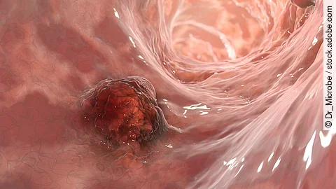 Rektumkarzinom: neue perioperative Radiochemeotherapie mit großem Potenzial