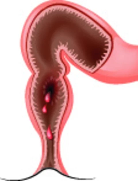 Schematische Darstellung des Enddarms mit sichtbarer Blutung