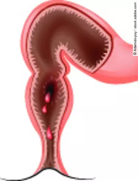 Schematische Darstellung des Enddarms mit sichtbarer Blutung