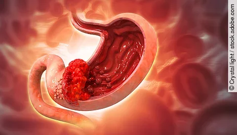 Neue Studiendaten zeigen: Magenkrebs wird in den USA zunehmend im Frühstadium erkannt. Neue Studiendaten zeigen: Magenkrebs wird in den USA zunehmend im Frühstadium erkannt.