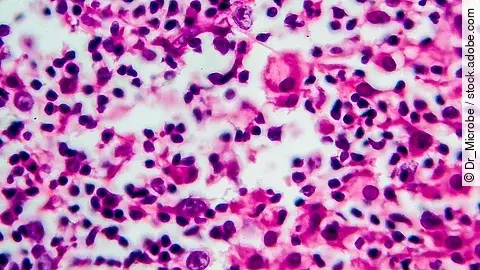 Histologischer Mikroskopieschnitt eines Hodgkin-Lymphoms mit zahlreichen Tumor- und Entzündungszellen in violett-rosa Färbung.