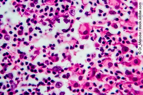 Hodgkin's lymphoma, light micrograph, photo under microscope