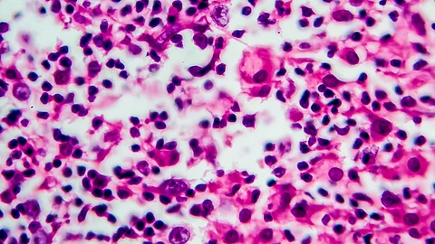 Histologischer Mikroskopieschnitt eines Hodgkin-Lymphoms mit zahlreichen Tumor- und Entzündungszellen in violett-rosa Färbung.