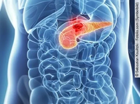 Tumor der Bauchspeicheldrüse