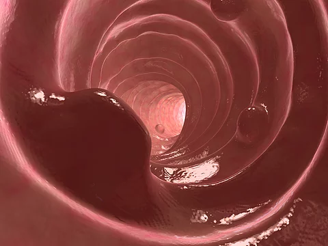darmpolypen darmpolypen