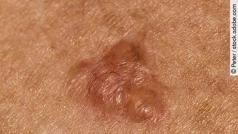 Basalzellkrazinom auf der Brust einer 70-jährigen Frau kaukasischer Herkunft