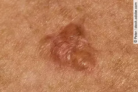 Basalzellkrazinom auf der Brust einer 70-jährigen Frau kaukasischer Herkunft