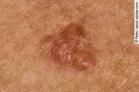 Basal cell carcinoma on the chest of a seventy year old Caucasian woman who has lived all her life in Africa