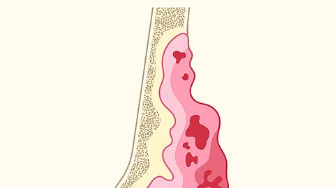 Illustration eines Knochens mit großflächigem Tumor in Rot- und Pinktönen, typisch für ein Ewing-Sarkom. Illustration eines Knochens mit großflächigem Tumor in Rot- und Pinktönen, typisch für ein Ewing-Sarkom.