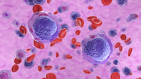 Akute myeloische Leukämie (AML)-Zellen im Blutkreislauf – isometrische Ansicht