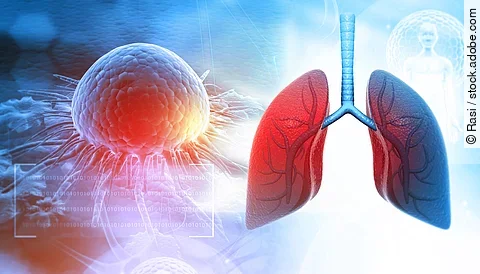 Human lungs anatomy with cancer cells