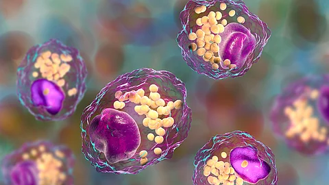 Makrophagen mit Lipidtröpfchen